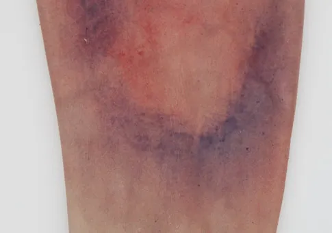 Water-Jel Leg Sleeves brannbandasje legg